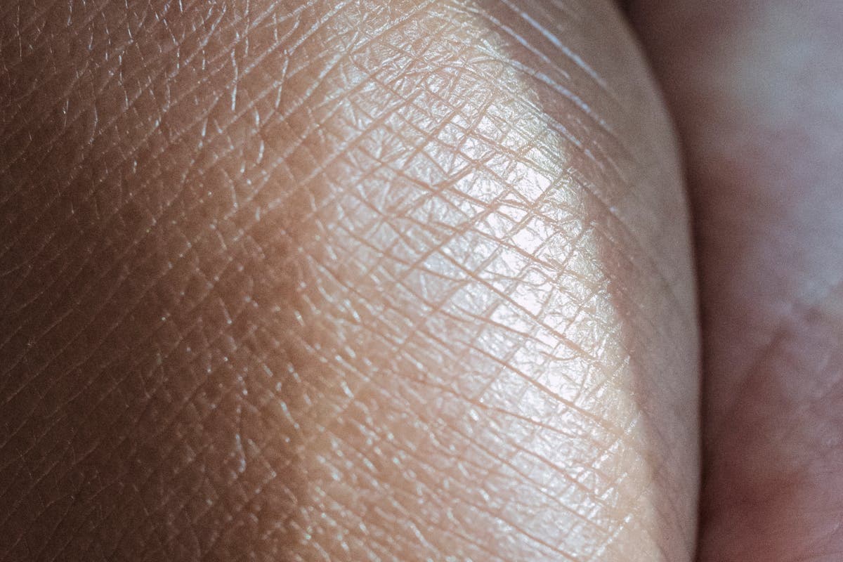 Nældefeber og hudkløe om sommeren: antihistaminer og creme
